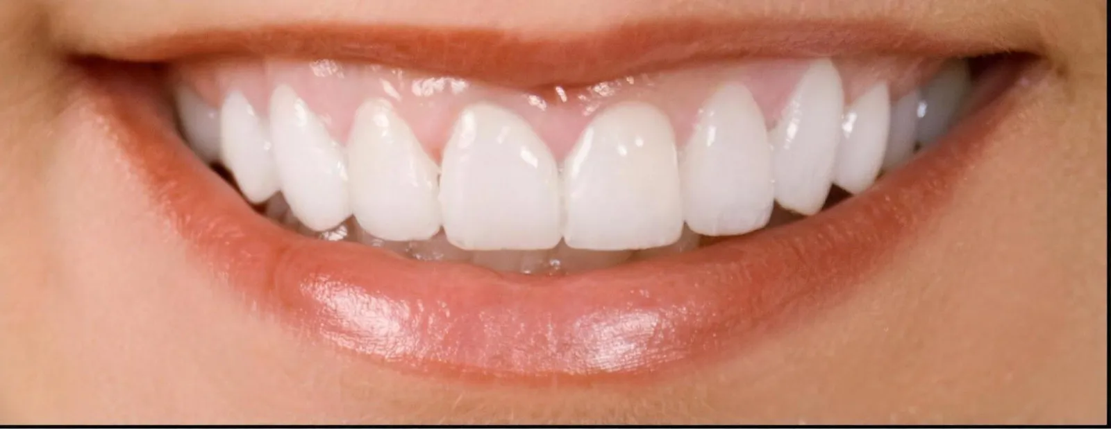 The same patient after treatment at Sarasota Smile Design, Sarasota, Florida