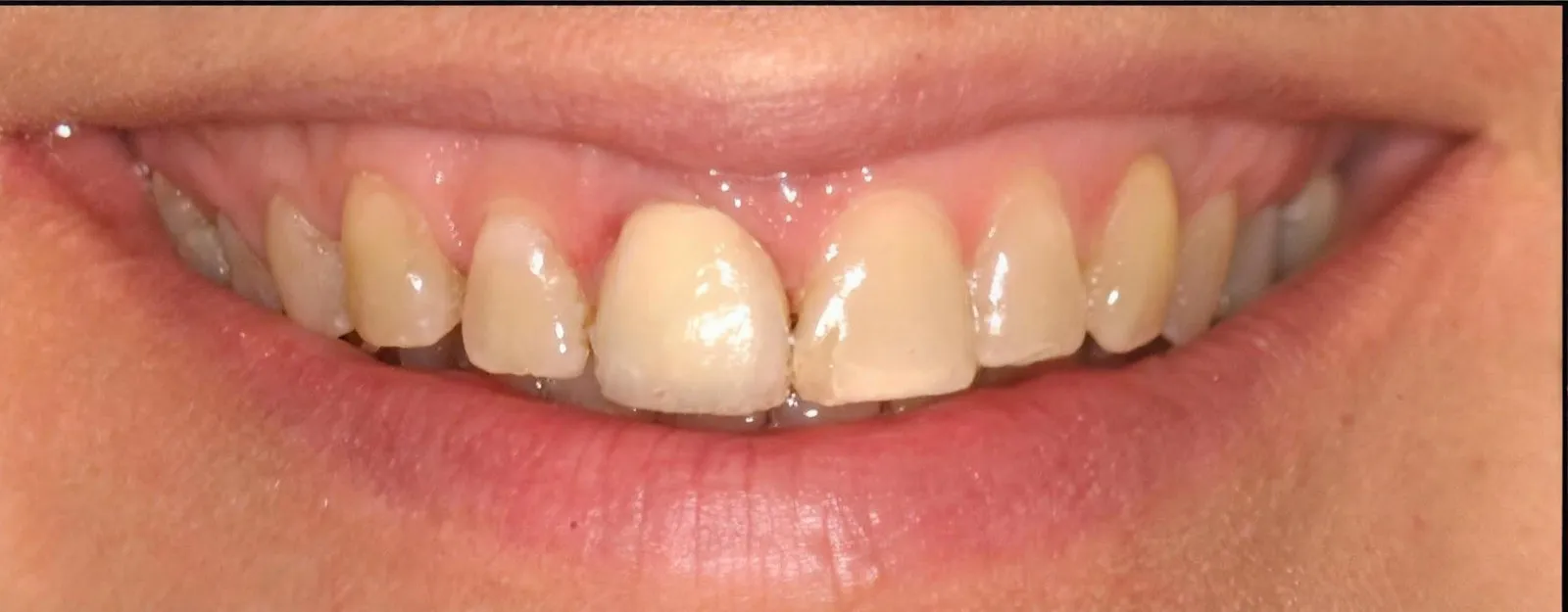 A patient of Sarasota Smile Design before treatment, Sarasota, Florida