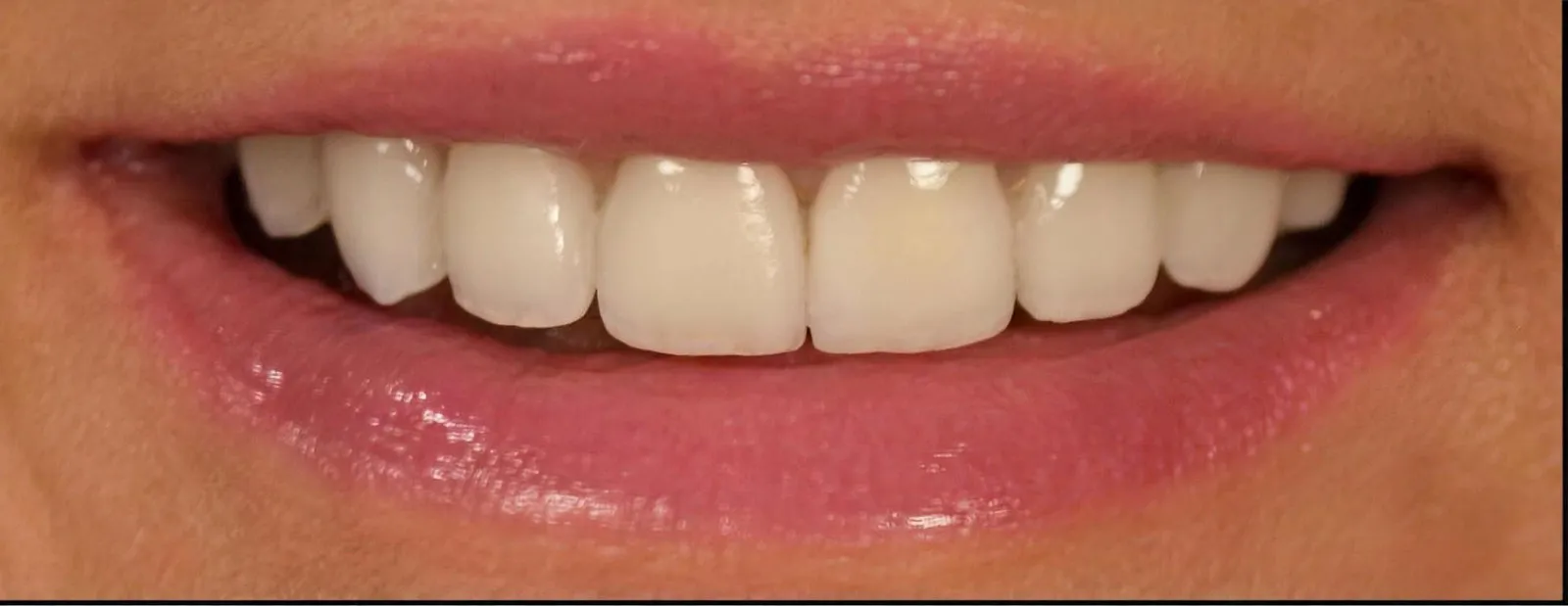 The same smile after treatment at Sarasota Smile Design in Sarasota, Florida, with the silver restorations replaced