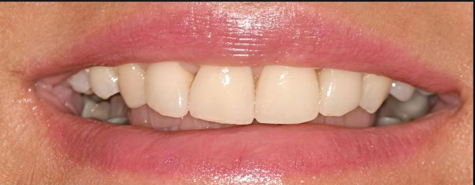The smile before treatment at Sarasota Smile Design in Sarasota, Florida, with dark silver restorations visible on the molars