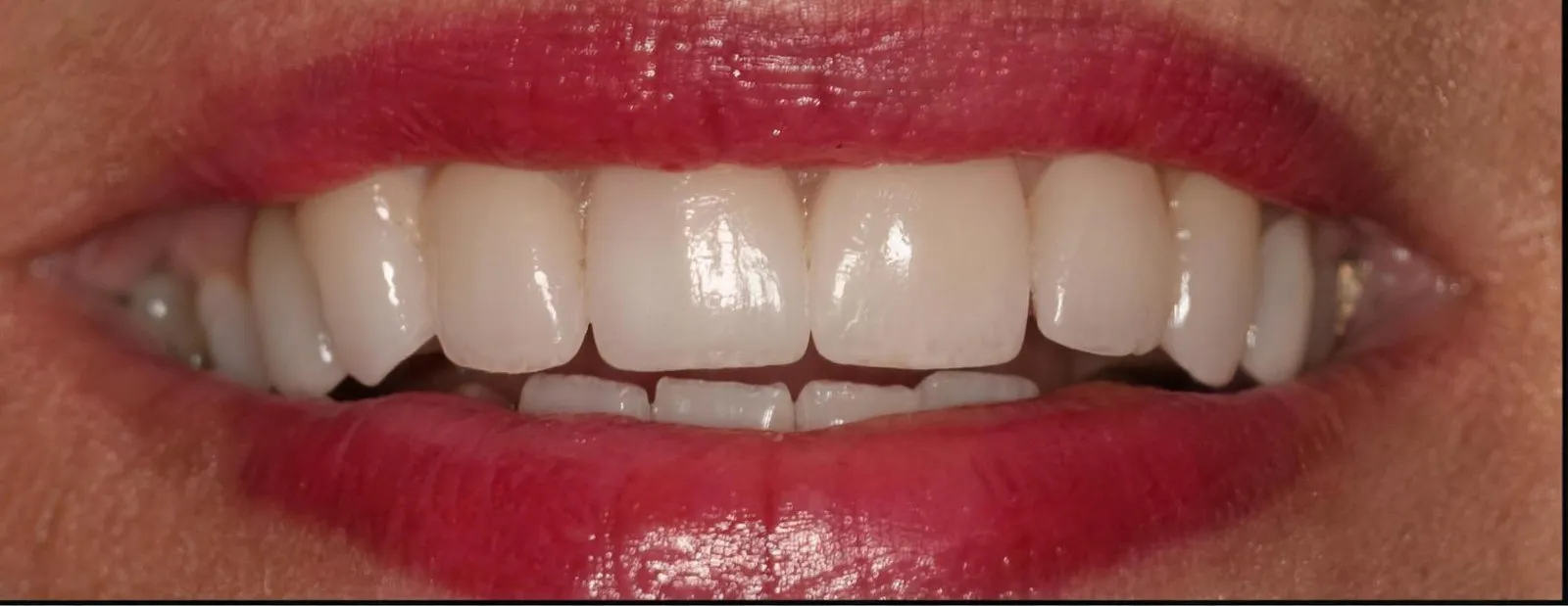 The same smile after treatment at Sarasota Smile Design in Sarasota, Florida