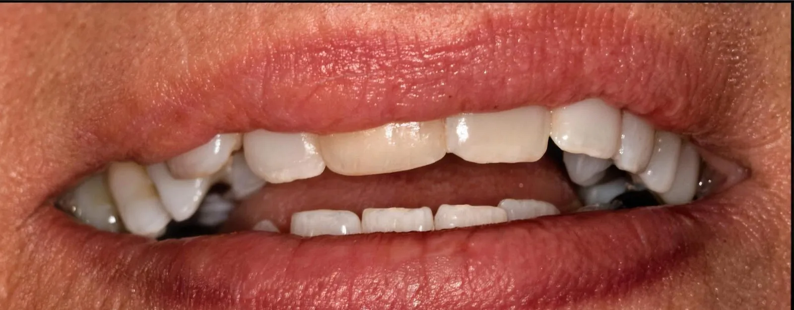 The smile before treatment at Sarasota Smile Design in Sarasota, Florida
