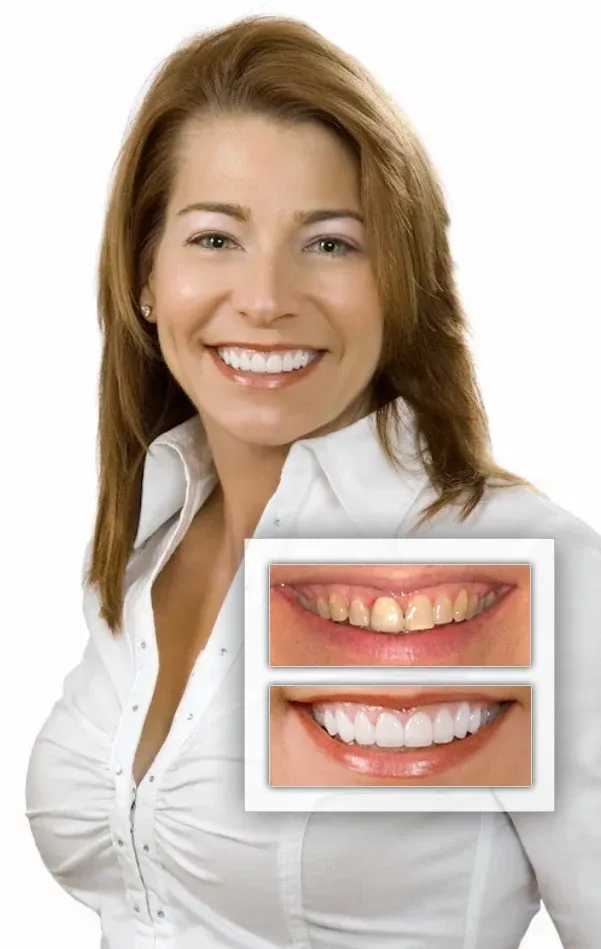 A cosmetic dentistry case at Sarasota Smile Design in Sarasota, Florida, photographed before and after