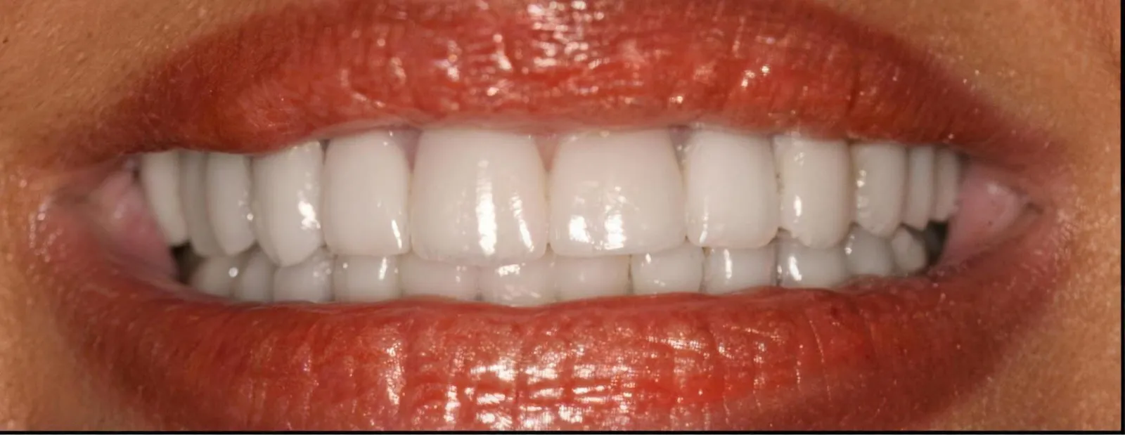 The same smile after treatment at Sarasota Smile Design in Sarasota, Florida