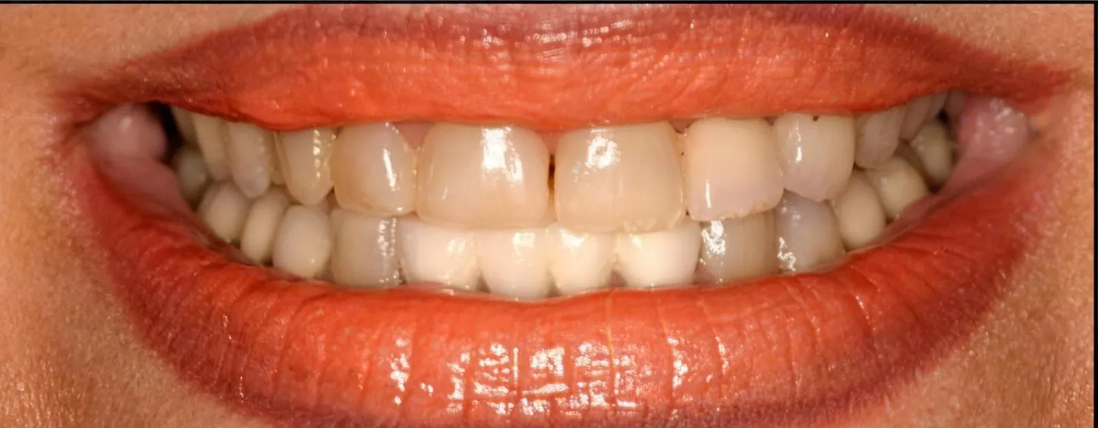 The smile before treatment at Sarasota Smile Design in Sarasota, Florida