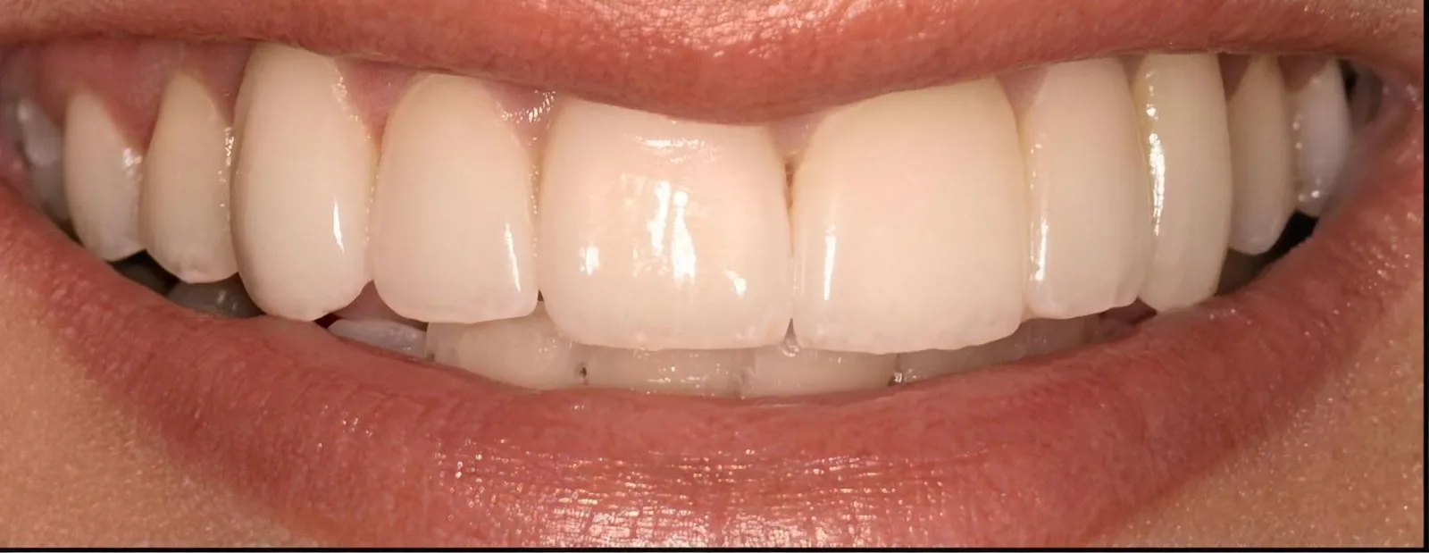 The same smile after treatment at Sarasota Smile Design in Sarasota, Florida