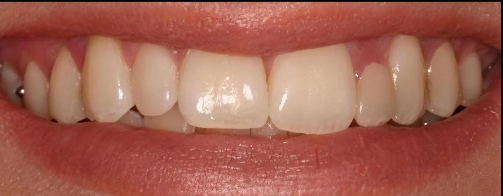 The smile before treatment at Sarasota Smile Design in Sarasota, Florida