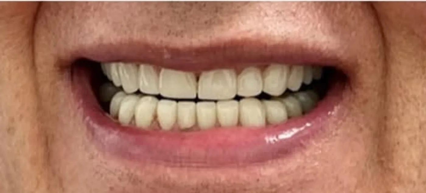 After treatment at Sarasota Smile Design in Sarasota, Florida