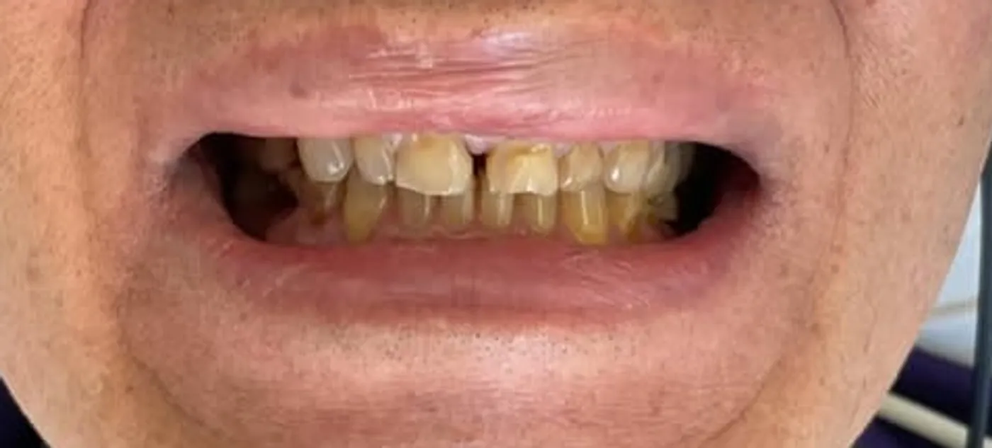 Before treatment at Sarasota Smile Design in Sarasota, Florida