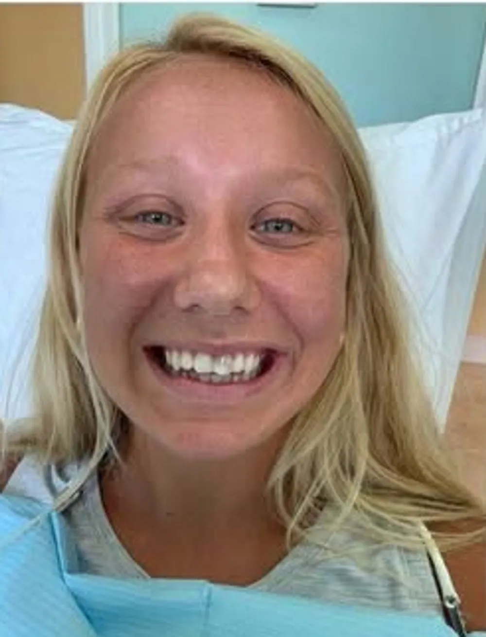 Before treatment at Sarasota Smile Design in Sarasota, Florida