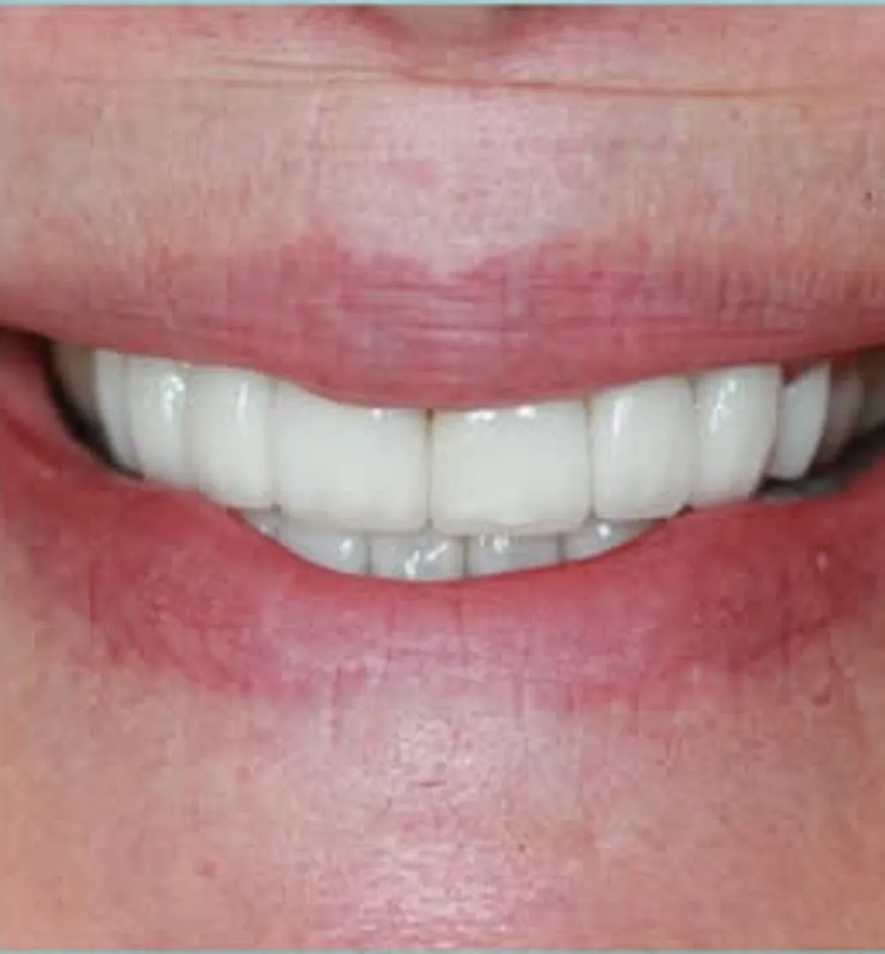 After treatment at Sarasota Smile Design in Sarasota, Florida