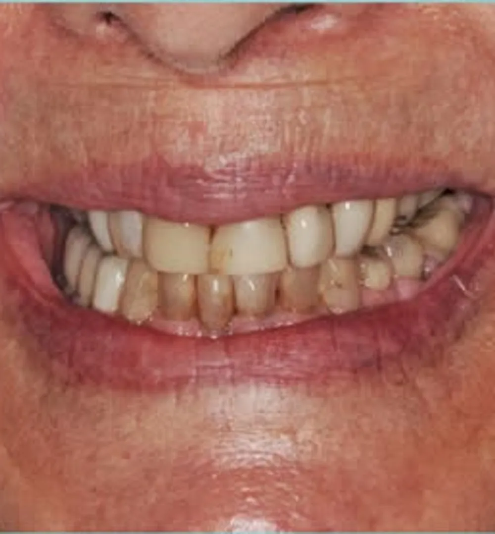 Before treatment at Sarasota Smile Design in Sarasota, Florida