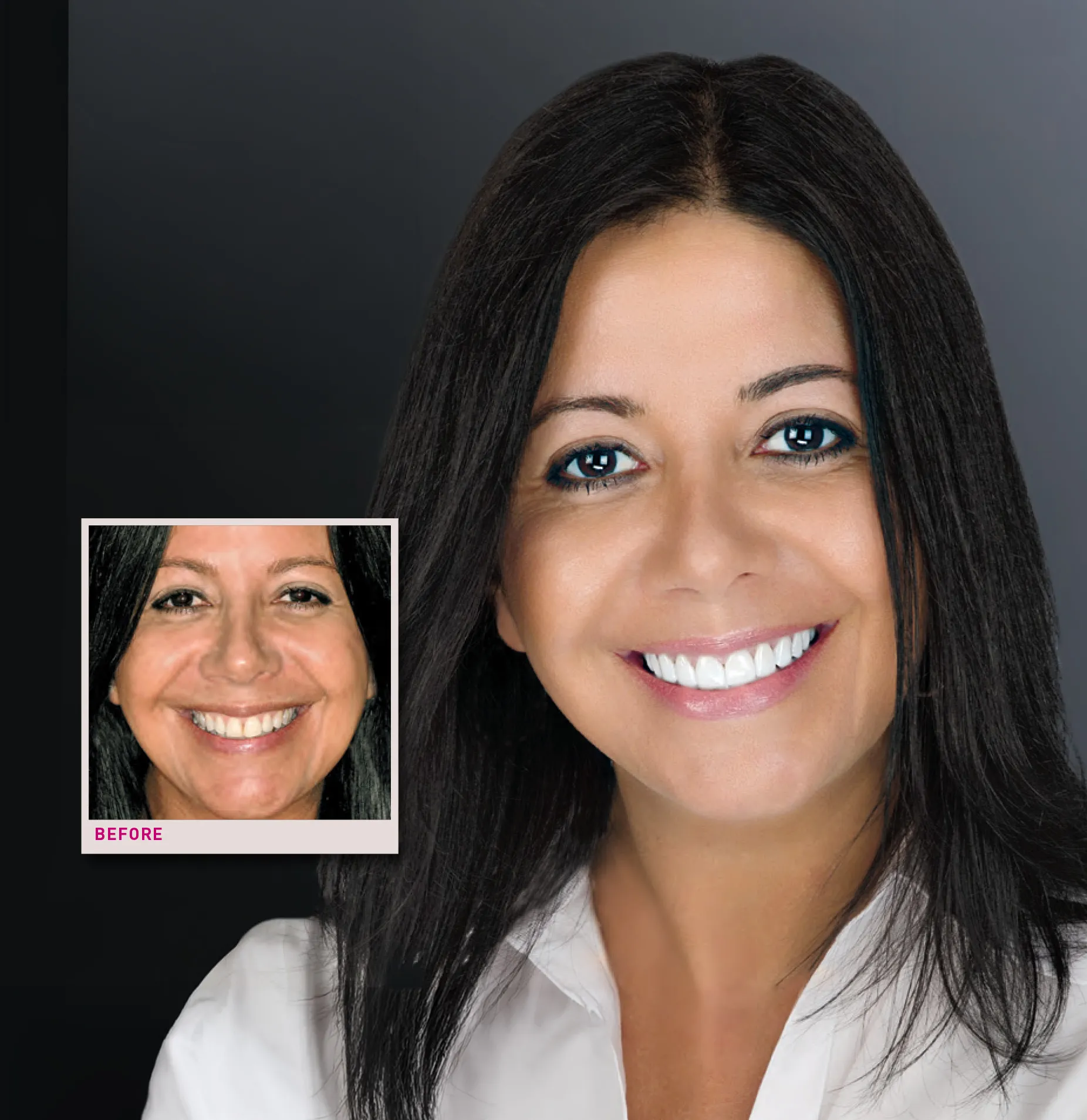 A smile makeover at Sarasota Smile Design in Sarasota, Florida, shown before and after