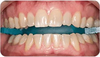 The initial shade of a patient's teeth recorded against a shade guide before whitening