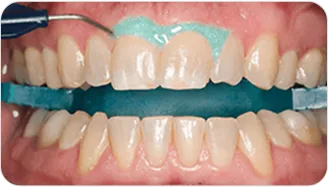 A protective barrier being applied along the gum line before whitening gel