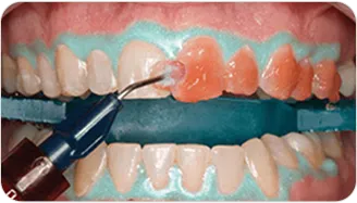 Opalescence Pro whitening gel being applied across the front teeth