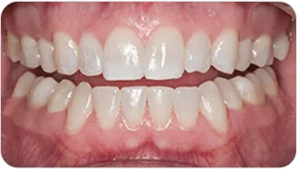 The same teeth after one in-office whitening appointment