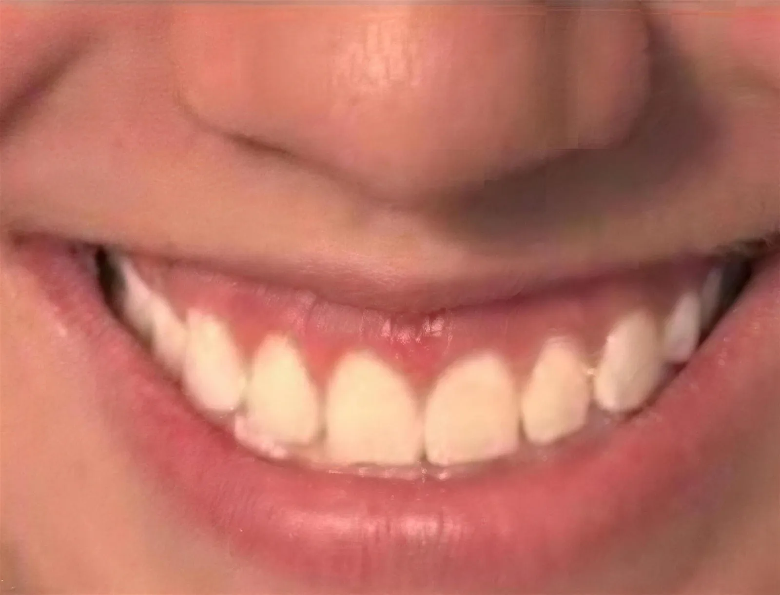 After treatment at Sarasota Smile Design in Sarasota, Florida