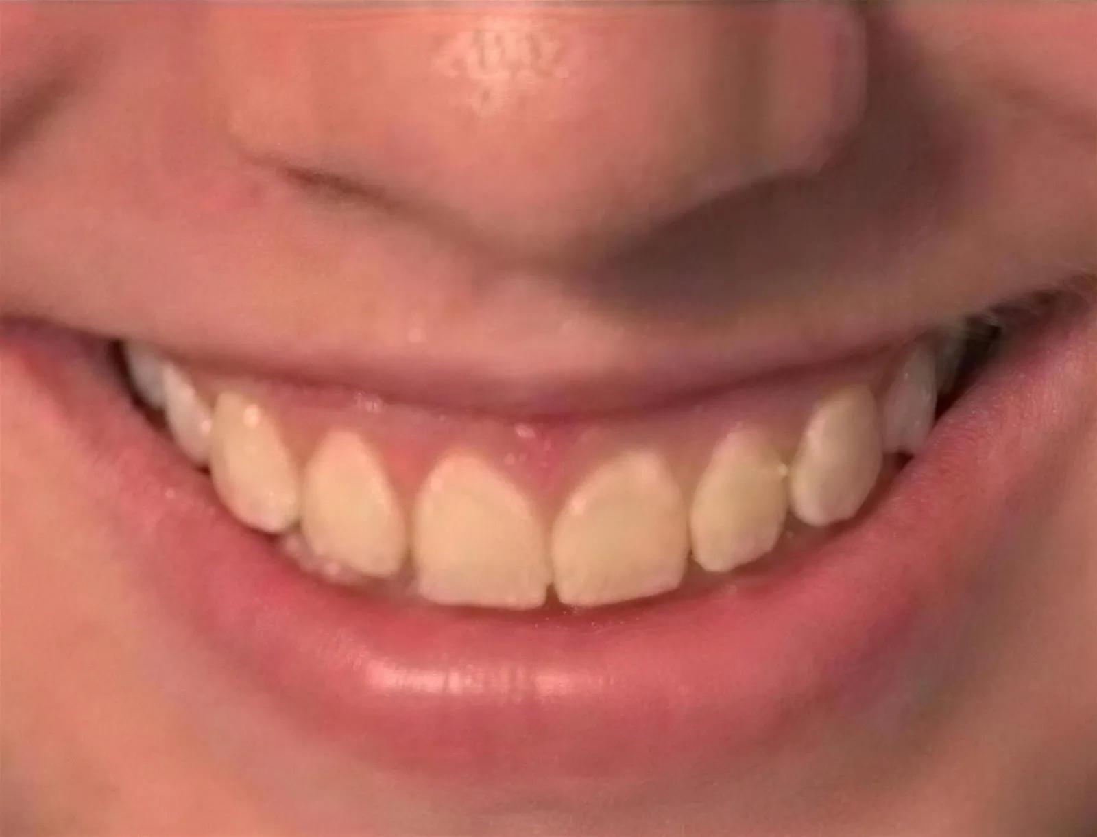 Before treatment at Sarasota Smile Design in Sarasota, Florida